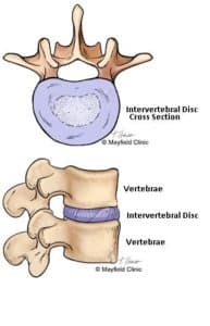 Discogenic Back Pain Morristown, NJ - Spine Specialists